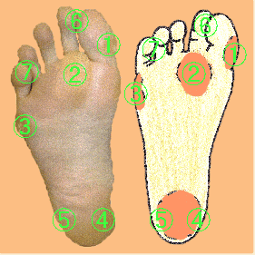 タコ 角質 ウオノメ Robinfoot Hp