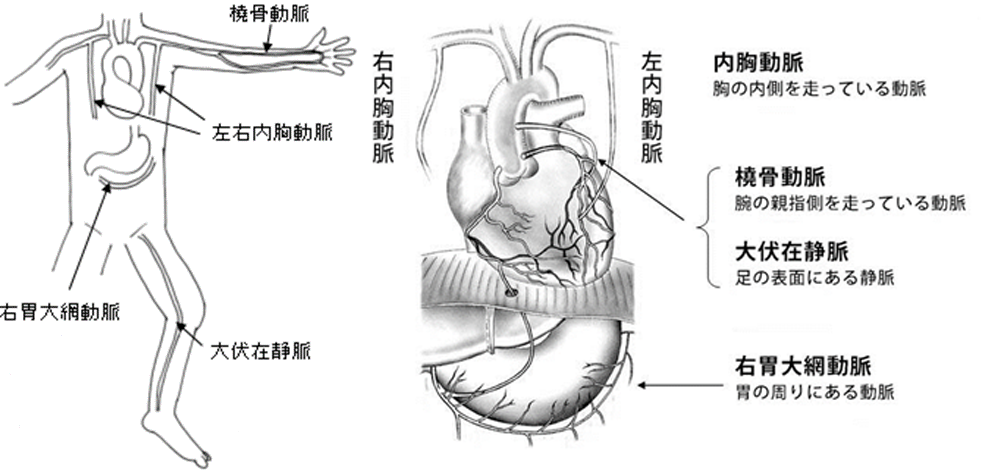 冠動脈バイパス手術