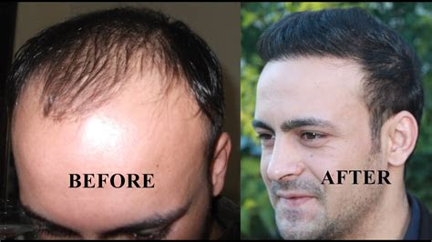 That depends on what you mean by normal. hair loss is very common—more than a third of all women experience it at some point— every i. Hair transplant before and after Hair Restoration Turkey