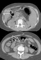 Extrahepatic manifestation of cirrhosis. Mesenteri
