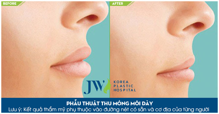 Phẫu thuật thẩm mỹ môi giá bao nhiêu