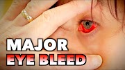 MAJOR EYE BLEED + (Possible Mono, Spleen Exam, & Blood Draw) | Dr. Paul