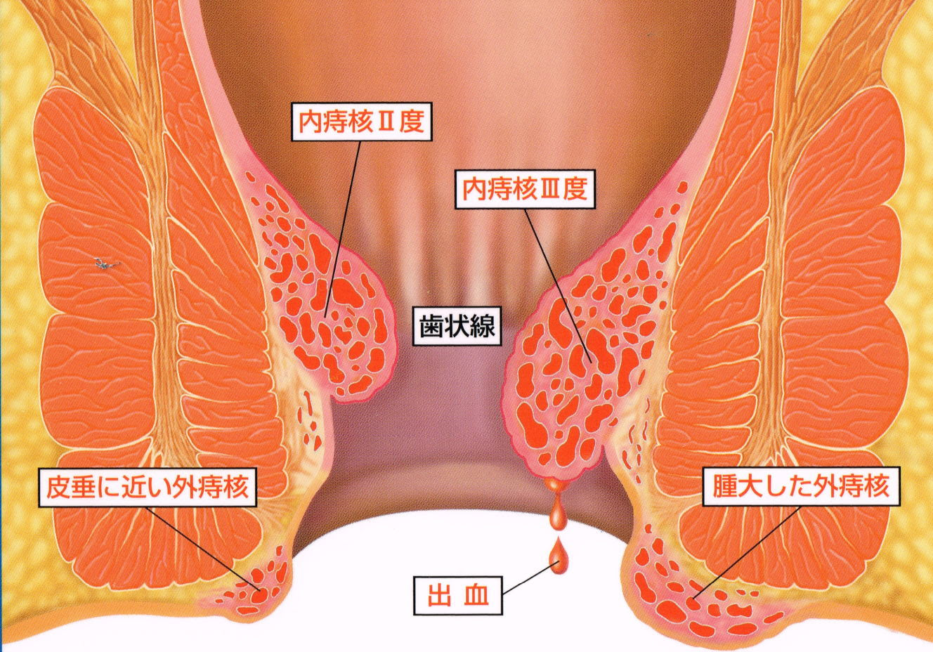 痔の種類－おしりの話 東京 肛門科 専門病院 いぼ痔 切れ痔 痔ろう