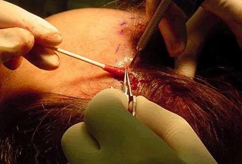 A patient undergoes a hair-replacement procedure in which micrografts are placed in slits made at an angle along the frontal hairline.
