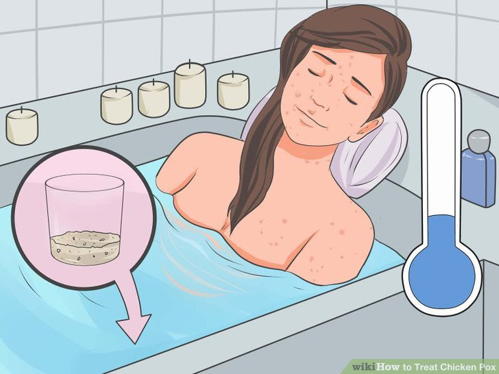 Treat Chicken Pox Step 12.jpg