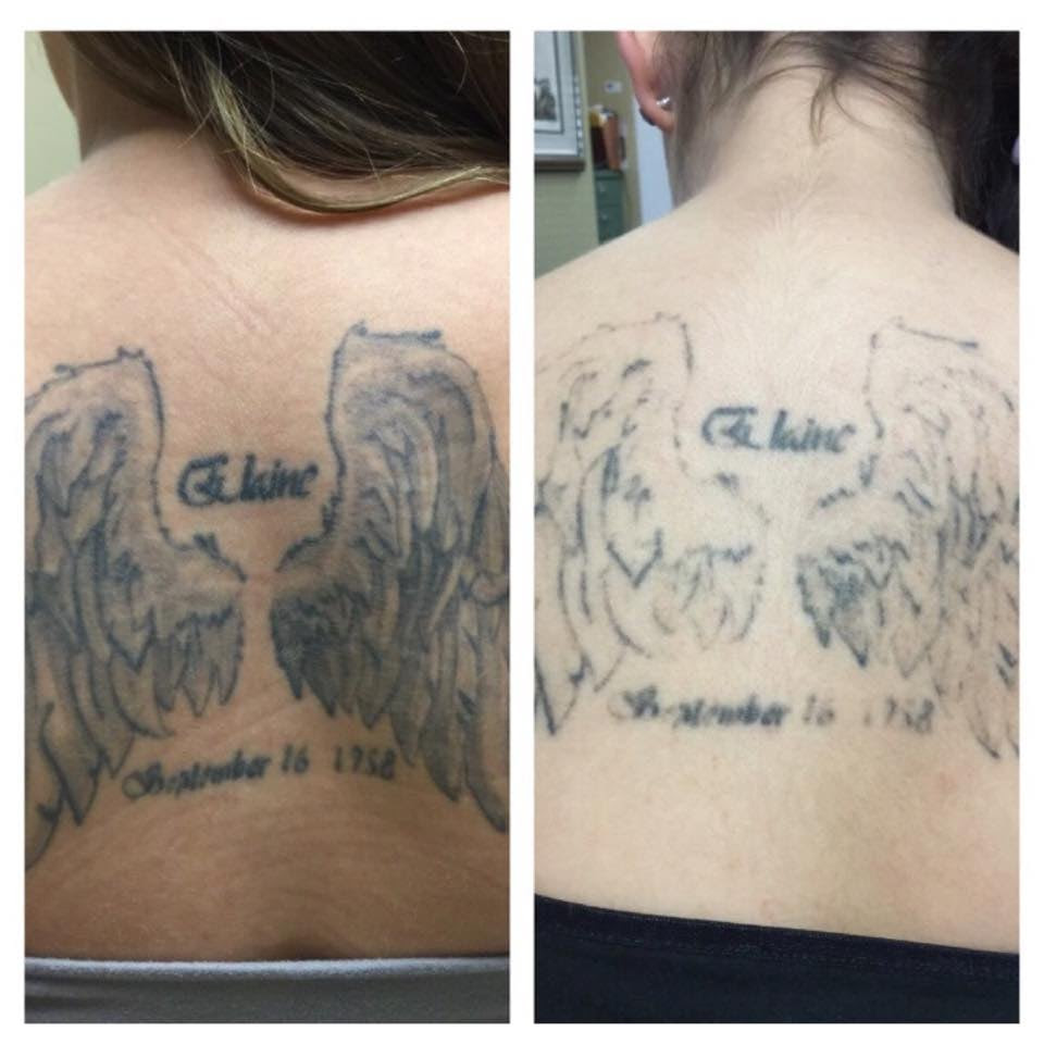 Absolute Laser Tattoo Removal - 18 Photos - Tattoo Removal 