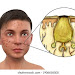 Hair Follicle Pimple : Acne around the hair follicle - Stock Image - C049/2248 - Science PhotoHair Follicle Pimple / Pin on Hair