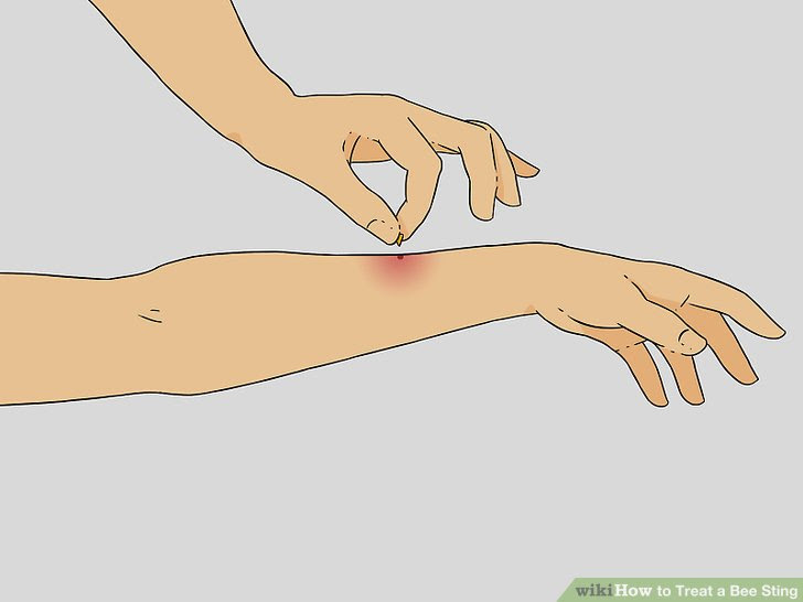 Treat a Bee Sting Step 1 Version 4.jpg