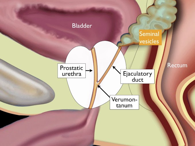Prostate Cancer Zone : Prostate MRI chronic prostatitis T2 hypointense transition : Prostate cancer is cancer of the prostate.the prostate is a gland in the male reproductive system that surrounds the urethra just below the bladder.