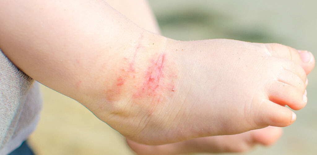 baby eczema cream and treatments lloydspharmacy