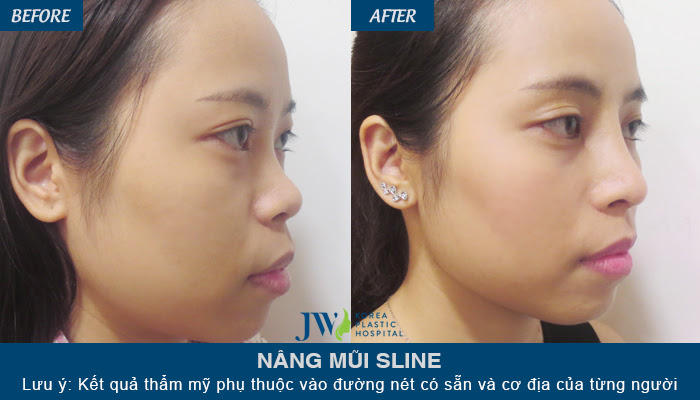 Hình ảnh khách hàng nâng mũi S line