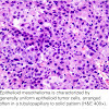 Pleural Mesothelioma Pathology Outlines : Pathology Outlines - Peritoneal malignant mesothelioma - Often associated with serosal fluid collection (pericardial, pleural,.