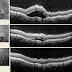 T Sign In Scleritis - 49 presented a sudden …