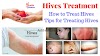 Hives Treatment