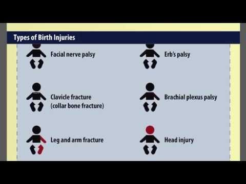 Video Birth Injury Attorney