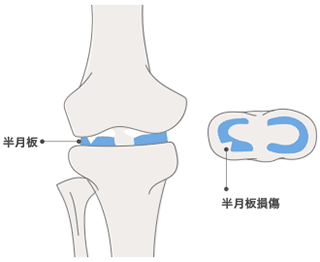 半月板損傷の症状と治療法 岐阜市 松岡整形外科 内科 リハビリテーション