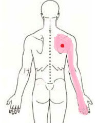肩から手のしびれには棘下筋へのトリガーポイント注射が効くよ にしぼり整形外科 茨城県笠間市