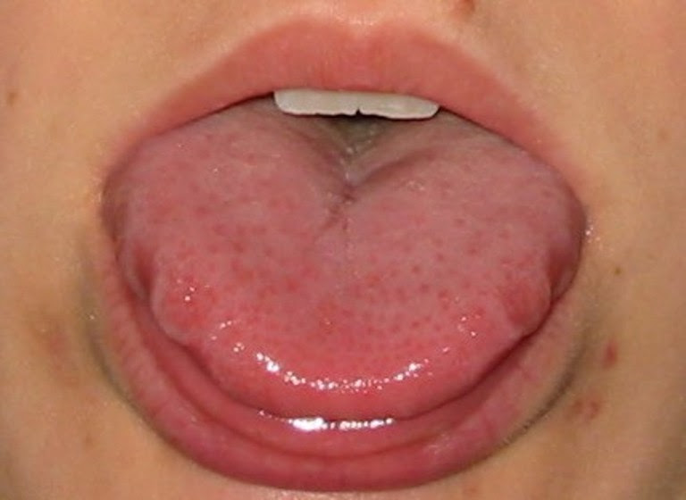 wavy tongue