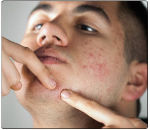 Face Pimples Face Pimples