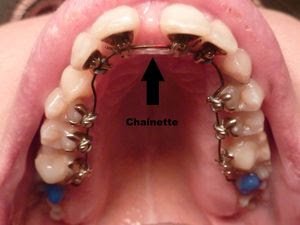 Fermeture d espaces inter-dentaires et diastmes en orthodontie