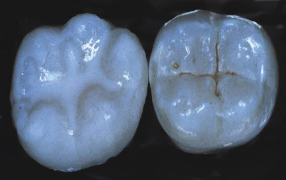 Dental Sealants Dentist in Melbourne Florida | Artistic ...