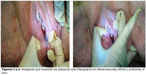 Liquen Escleroso Y Atrofico Genital O Craurosis De La Vulva Presentacion De Un Caso