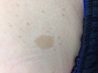 レックリング ハウゼン病