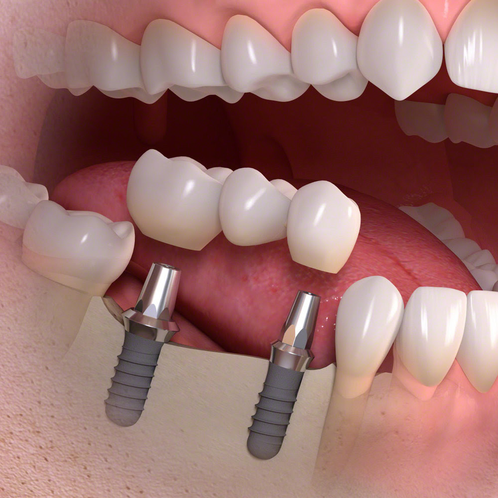  Full Mouth Implants In Airoli