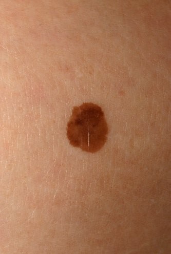 Skin Cancer Mole Names - How Can You Tell If It's a Mole or Skin Cancer? | Mole