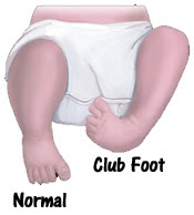 Club Foot Shoes For Talipes Equinovarus Factory Prices