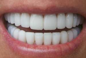 full mouth case