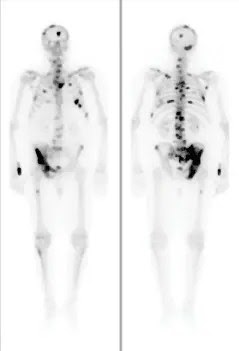 Prostate Cancer Staging Pt3A / Osteoblastic spinal metastases from prostate cancer : A diagnosis of lung cancer naturally causes some overwhelming emotions, but you don’t have to let those emotions get the best of you.