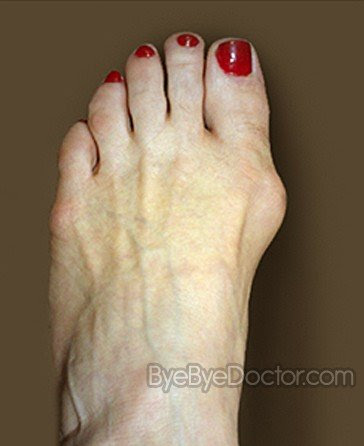 bunion 3