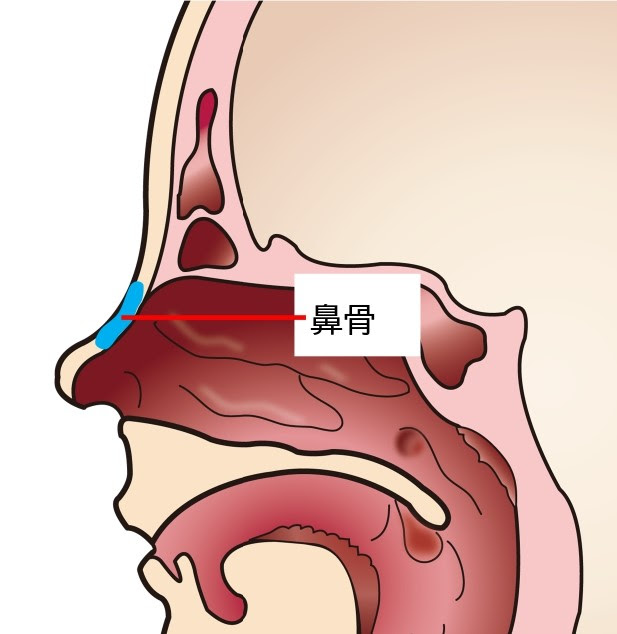 鼻骨骨折 びこつこっせつ 楓みみはなのどクリニック 一宮市