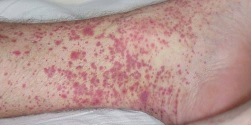 Hemorrhagic Marburg fever: treatment, causes, symptoms ...