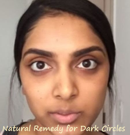 Natural Remedy for Dark Circles Under Eyes