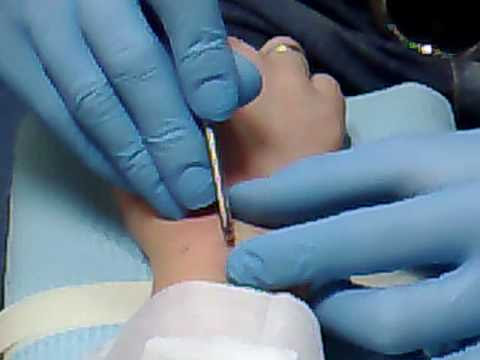 Mijn eerste micro dermal anchor, geplaatst op m'n pols. Mijn eerste micro dermal anchor, geplaatst op m'n pols.
