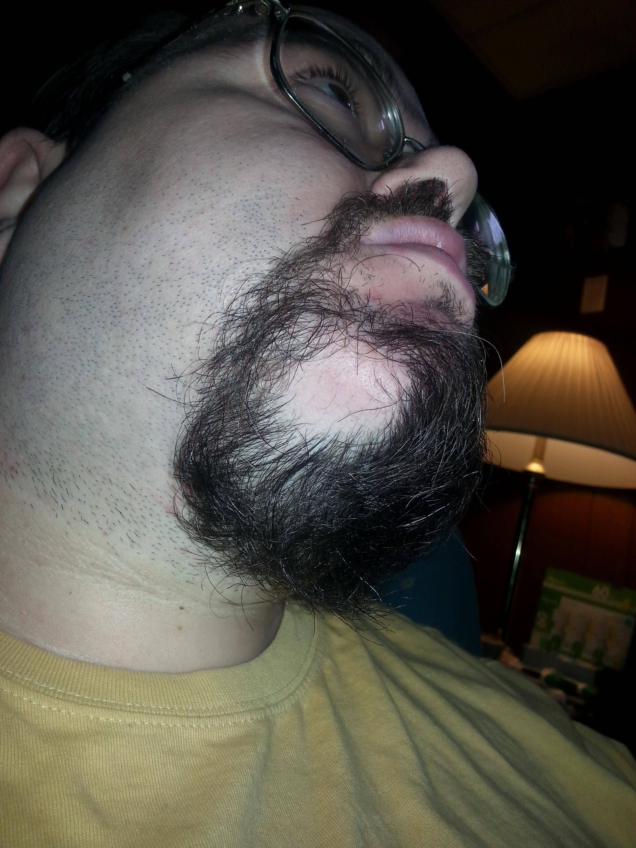 Any reason why a person would develop a bald spot on their chin who has  always had a full beard? : pics