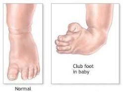 Club Foot Treatment And Management Kerala