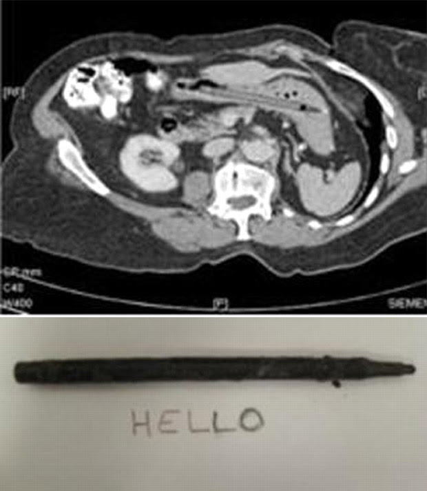 Na imagem de cima, tomografia em que a caneta aparece dentro do estômago da paciente. Abaixo, a demonstração de que o objeto ainda funcionava. (Foto: Reprodução)