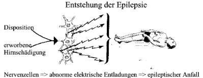 Epilepsie Fokale Und Generalisierte Epileptische Anfalle Und Epilepsien Absencen Grand Mal