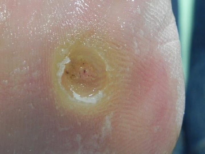 尋常性疣贅その2 魚の目とは違うんだよ 魚の目とは 二条駅前 なかみち皮膚科クリニック