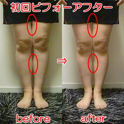 名古屋 天白 リンパマッサージで脚やせ 太ももダイエット ｏ脚矯正 ｘ脚矯正 美脚専門サロン天白区植田ミストグラス