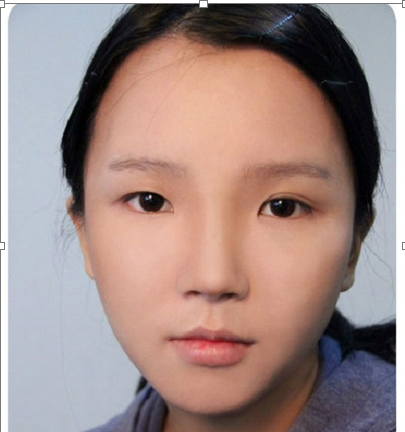 hai mắt lệch nhau1 