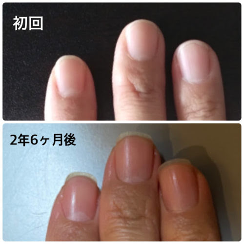 爪の変化で 指も細く長く お客さまのビフォーアフター 自爪ケア専門サロン イニュラ