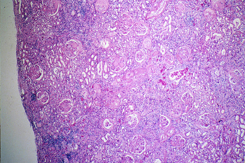 kidney disorder facts