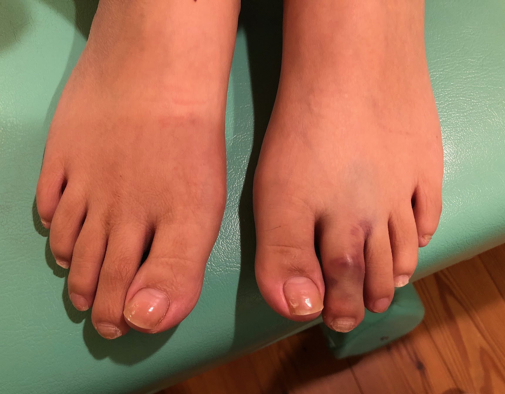 足の指をぶつけて痛い 内出血している 足の指の骨は折れやすい 放っておかずに早目に治療しましょう すみだ整骨院 直方 飯塚 田川 八幡で整骨院なら