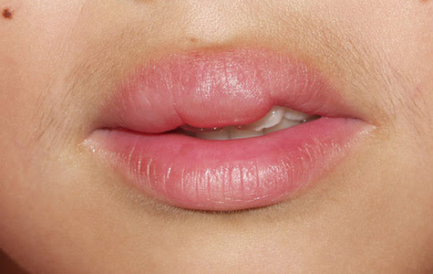 唇のトラブル 完全網羅 できもの ひやけ しびれ 腫れ ニキビ徹底解説 どくらぼ