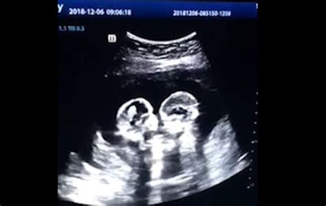 identical twin babies shown  ultrasound fighting