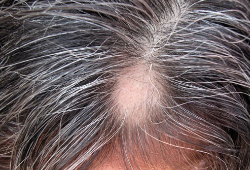 Top 12 Remedies to Stop Hair Loss | New Health Advisor